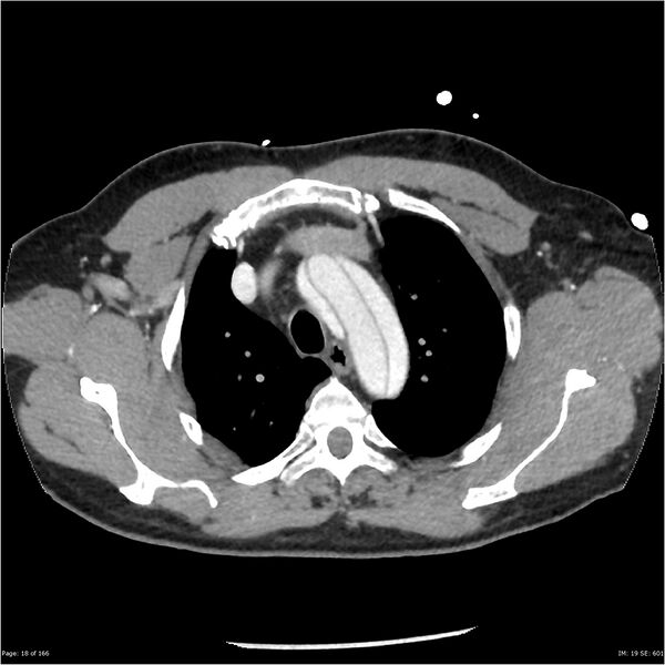 File:Aortic dissection- Stanford A (Radiopaedia 37759-39664 A 9).jpg