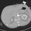 Aortic dissection - DeBakey type II (Radiopaedia 64302-73082 Axial lung window 66).png