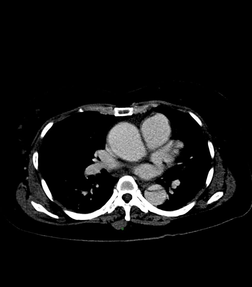 Aortic dissection with renal ischemia (Radiopaedia 76573-88338 B 14).jpg