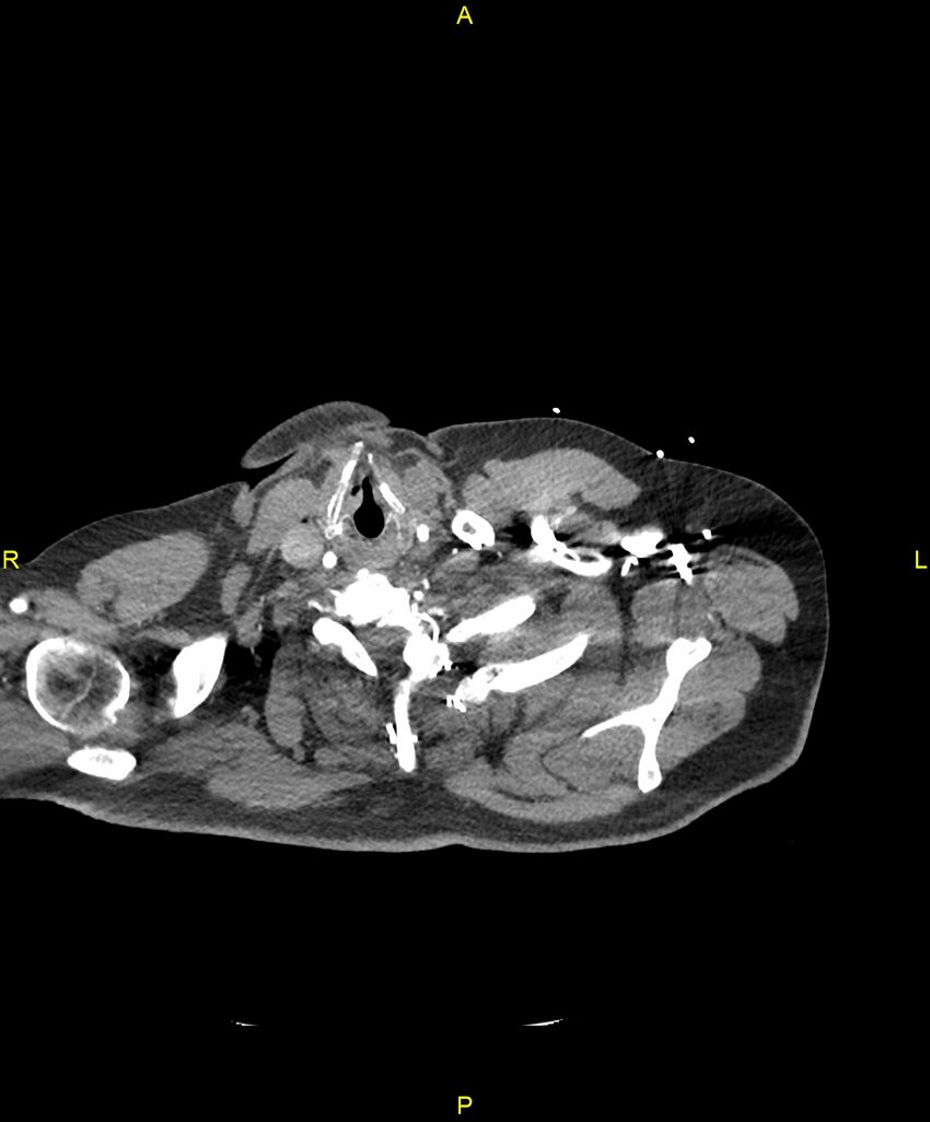Aortic rupture (Radiopaedia 88822-105594 B 2).jpg