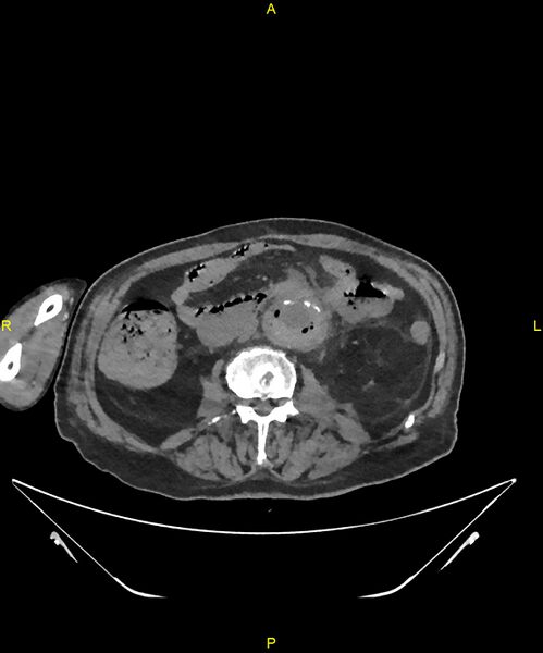 File:Aortoenteric fistula (Radiopaedia 84308-99603 Axial non-contrast 184).jpg
