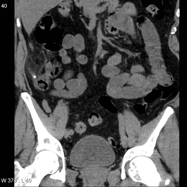 File:Appendicitis (Radiopaedia 12510-12733 Coronal non-contrast 10).jpg
