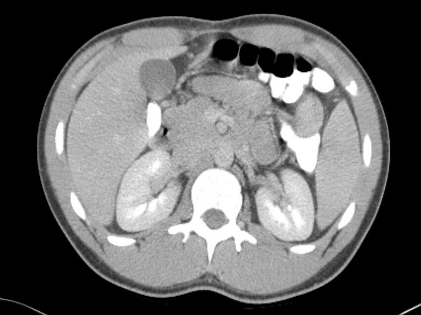Appendicitis and incidental foregut duplication cyst (Radiopaedia 52962-58916 A 12).jpg