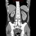 Appendicitis and renal cell carcinoma (Radiopaedia 17063-16760 B 22).jpg