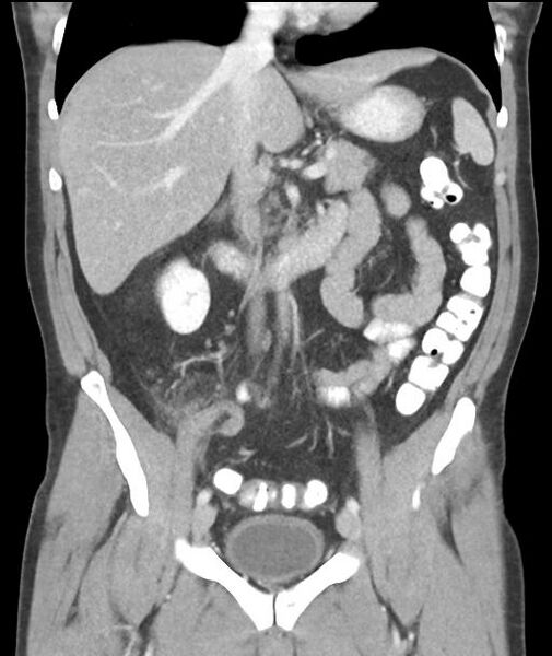 File:Appendicitis with cecal bar sign (Radiopaedia 31878-32830 A 31).jpg