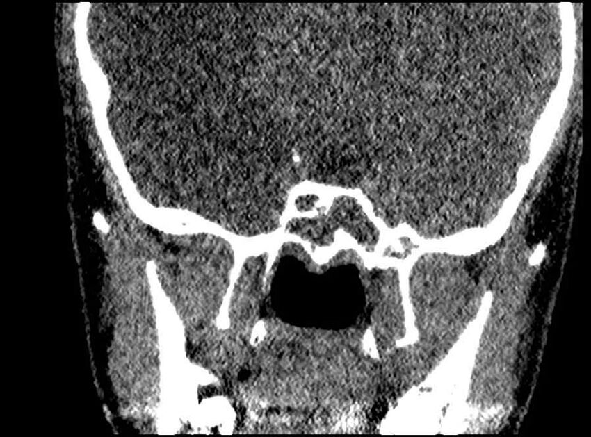 Arachnoid cyst- extremely large (Radiopaedia 68741-78450 Coronal bone window 17).jpg
