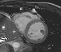 Arrhythmogenic right ventricular cardiomyopathy (Radiopaedia 39806-42237 F 23).jpg