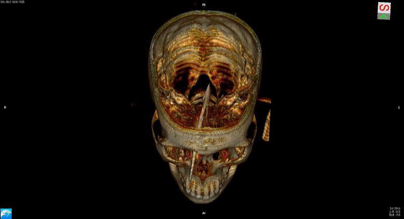File:Arrow injury to the brain (Radiopaedia 72101-82607 3D bone 15).jpg