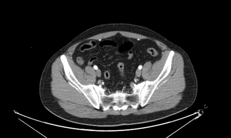 File:Arterial occlusive mesenteric ischemia (Radiopaedia 84641-100060 A 105).jpg