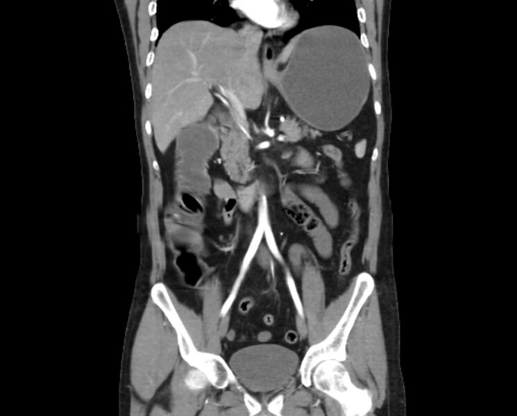 File:Arterial occlusive mesenteric ischemia (Radiopaedia 84641-100060 B 28).jpg