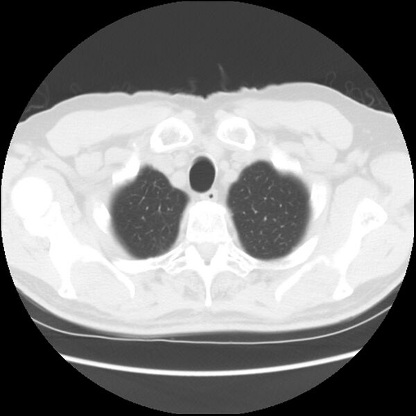 File:Asbestos-related pleural plaques (Radiopaedia 39069-41255 Axial lung window 8).jpg