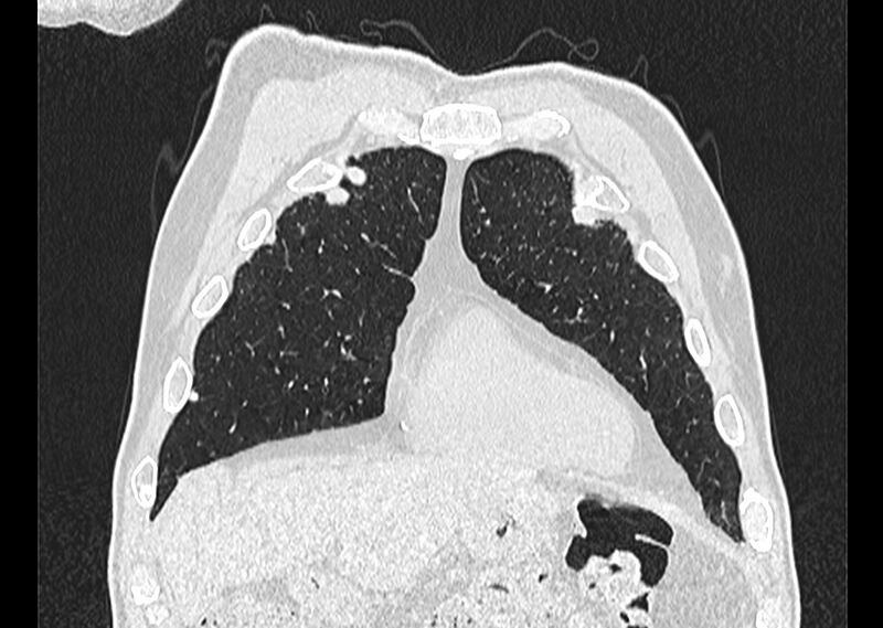 File:Asbestos pleural placques (Radiopaedia 57905-64872 Coronal lung window 45).jpg