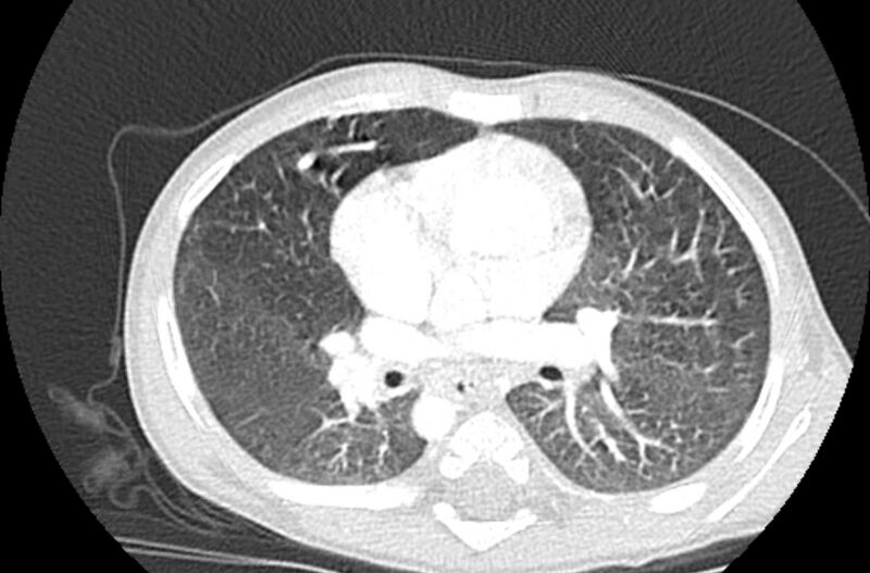 File:Asplenia syndrome (Radiopaedia 73083-83792 Axial lung window 33).jpg
