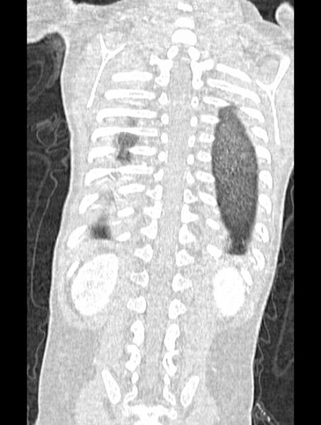 File:Asplenia syndrome (Radiopaedia 73083-83792 Coronal lung window 120).jpg