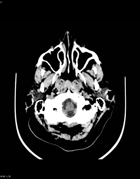 File:Astroblastoma (Radiopaedia 39792-42216 Axial non-contrast 3).jpg