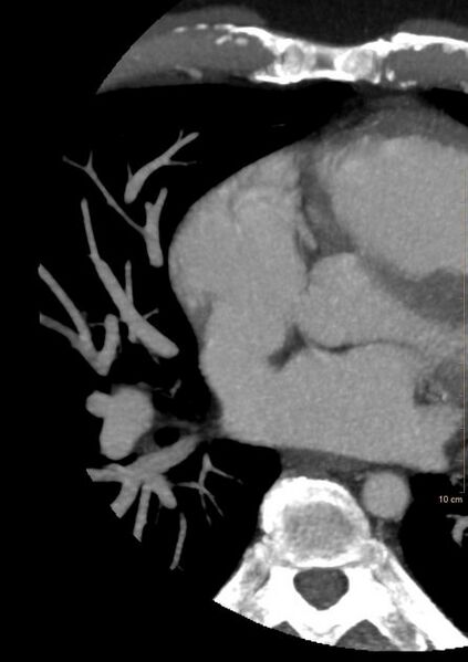 File:Atrial septal defect (upper sinus venosus type) with partial anomalous pulmonary venous return into superior vena cava (Radiopaedia 73228-84051 C+ arterial phase 8).jpeg