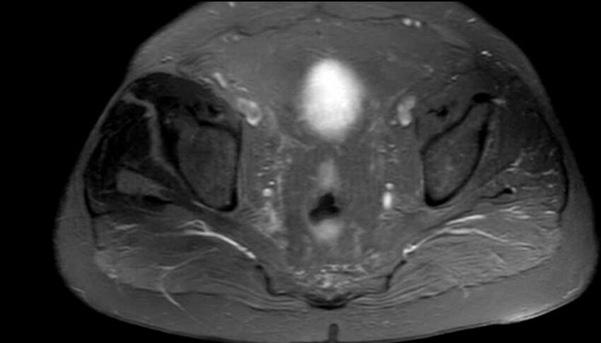 Atypical lipomatous tumor - thigh (Radiopaedia 68975-78734 Axial PD fat sat 100).jpg