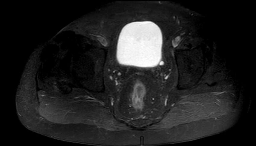 Atypical lipomatous tumor - thigh (Radiopaedia 68975-78734 Axial T1 C+ fat sat 97).jpg