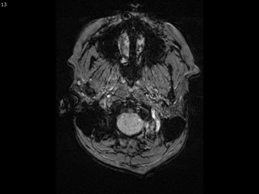 Atypical meningioma - intraosseous (Radiopaedia 64915-74572 Axial SWI 13).jpg