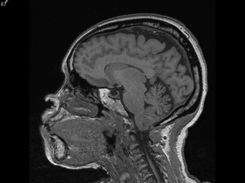 Atypical meningioma - intraosseous (Radiopaedia 64915-74572 Sagittal T1 87).jpg