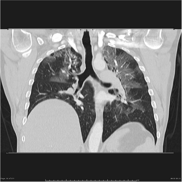 File:Atypical pneumonia - Q fever (Radiopaedia 21993-21989 C 24).jpg