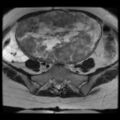 Atypical retroperitoneal lymphocoeles with large leiomyoma of uterus (Radiopaedia 32084-33027 Axial T2 12).jpg