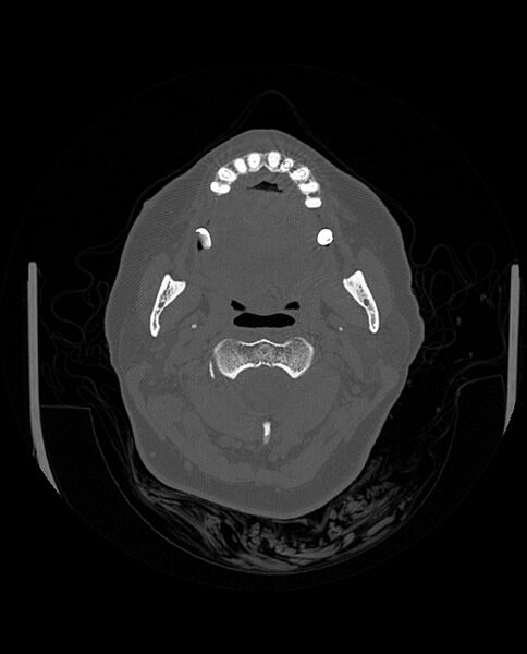 File:Automastoidectomy with labyrinthine fistula (Radiopaedia 84143-99411 Axial non-contrast 19).jpg