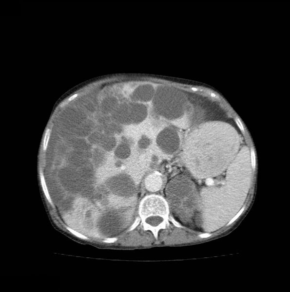 File:Autosomal dominant polycystic kidney disease (Radiopaedia 16777-16490 A 16).jpg