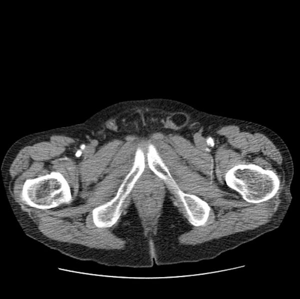 File:Autosomal dominant polycystic kidney disease (Radiopaedia 27851-28094 B 125).jpg