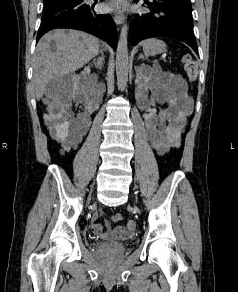 File:Autosomal dominant polycystic kidney disease (Radiopaedia 87830-104287 Coronal non-contrast 38).jpg