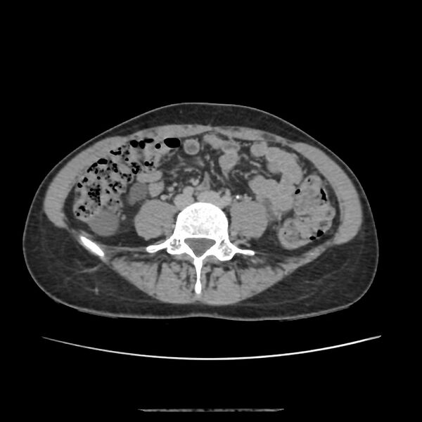 File:Autosomal dominant polycystic kidney disease - early onset (Radiopaedia 40734-43387 D 15).jpg
