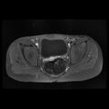 Avascular necrosis of the hip (Radiopaedia 29563-30067 Axial T1 C+ fat sat 3).jpg