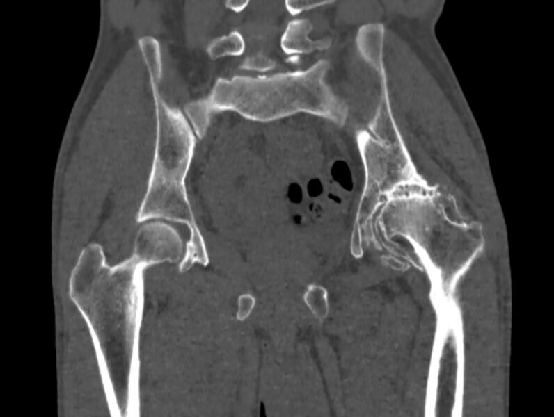 File:Avascular necrosis of the left hip (Radiopaedia 75068-86125 Coronal bone window 41).jpg