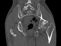 Avascular necrosis of the left hip (Radiopaedia 75068-86125 Coronal bone window 66).jpg
