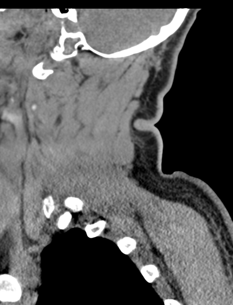 File:Axis peg fracture (type 3) and atlas lateral mass (type 4) fracture (Radiopaedia 37474-39324 D 16).png