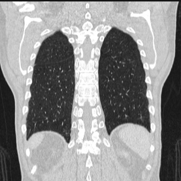 File:Azygos lobe (Radiopaedia 38259-40275 Coronal lung window 64).jpg