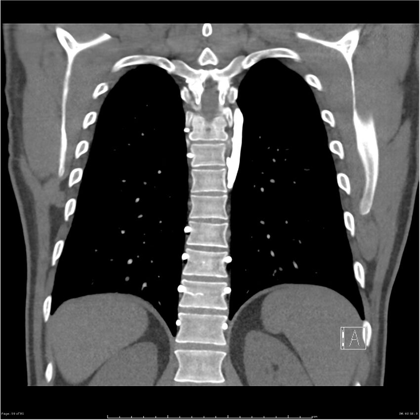 Azygos venous system anatomy (CT pulmonary angiography) (Radiopaedia 25928-26077 Coronal C+ CTPA 59).jpg