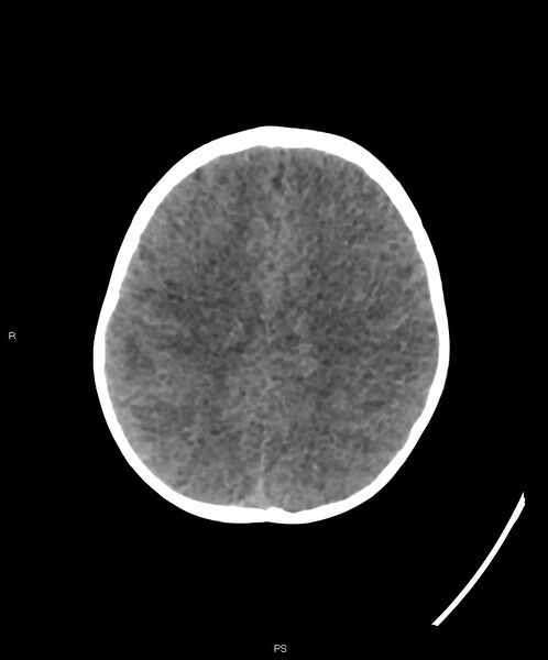 File:Basal ganglia and parenchymal ischemia (Radiopaedia 45818-50083 Axial non-contrast 13).jpg
