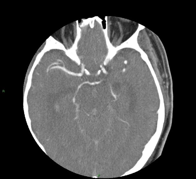 File:Basal ganglia hemorrhage (Radiopaedia 58763-65985 D 76).jpg