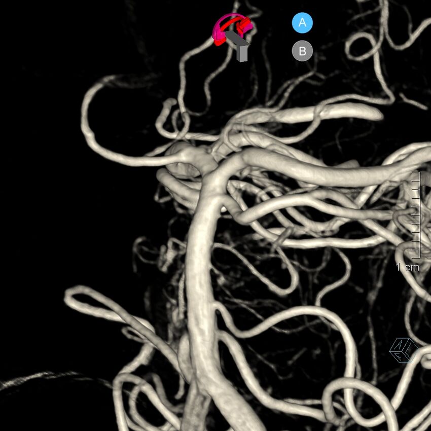 Basilar artery perforator aneurysm (Radiopaedia 82455-97734 3D view left VA 103).jpg