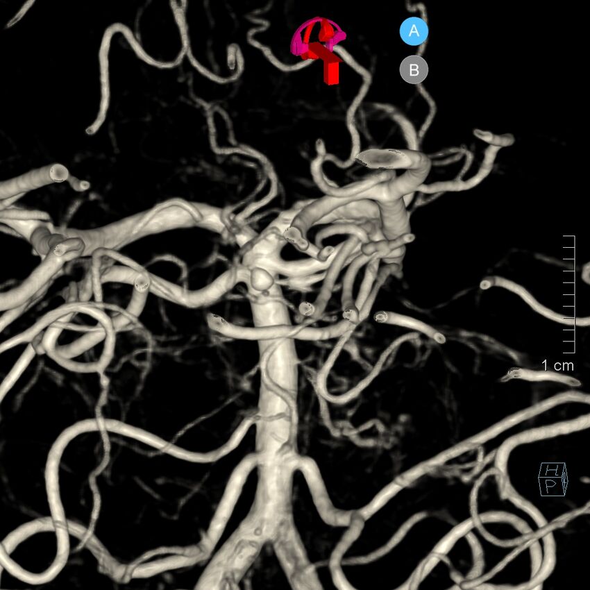Basilar artery perforator aneurysm (Radiopaedia 82455-97734 3D view left VA 156).jpg