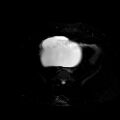 Benign seromucinous cystadenoma of the ovary (Radiopaedia 71065-81300 T2 SPAIR 17).jpg