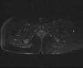 Bicornuate bicollis uterus (Radiopaedia 61626-69616 Axial PD fat sat 34).jpg