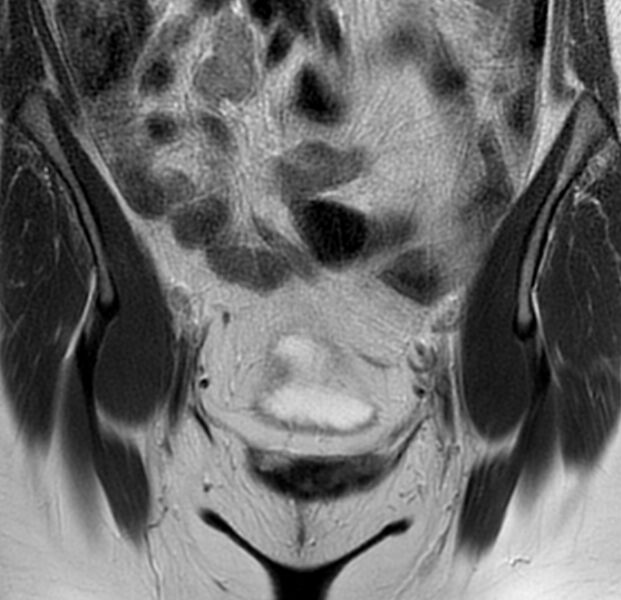 File:Bicornuate uterus (Radiopaedia 76407-88114 Coronal T2 2).jpg