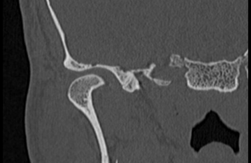 File:Bilateral cholesteatoma (Radiopaedia 54898-61172 Coronal bone window 2).jpg