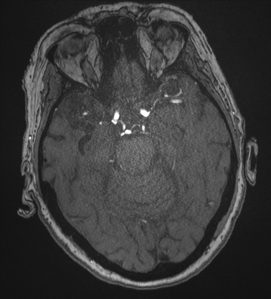 File:Bilateral fetal posterior communicating arteries (Radiopaedia 41286-44102 Axial MRA 74).png