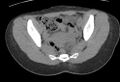 Bilateral mature cystic ovarian teratoma (Radiopaedia 88821-105592 Axial non-contrast 15).jpg