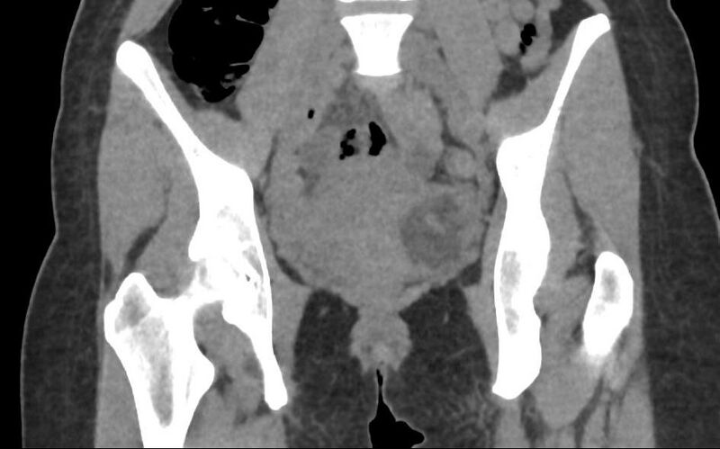 File:Bilateral mature cystic ovarian teratoma (Radiopaedia 88821-105592 Coronal non-contrast 14).jpg