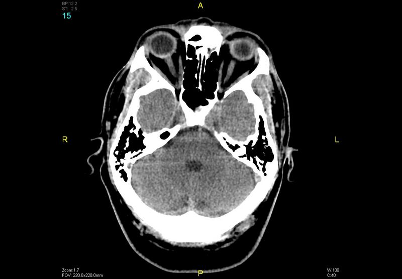 File:Bilateral medial medullary infarction (Radiopaedia 42220-45295 Axial non-contrast 15).jpg