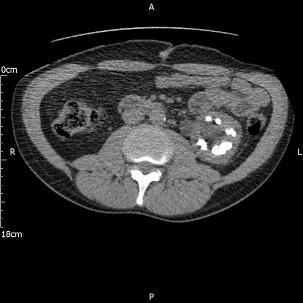 File:Bilateral medullary nephrocalcinosis with ureteric calculi (Radiopaedia 71269-81569 Axial non-contrast 57).jpg